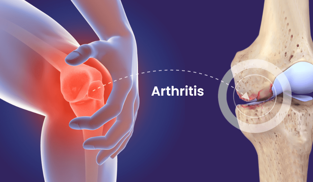 Physiotherapy for Arthritis: Effective Exercises and Strategies to Ease Joint Pain